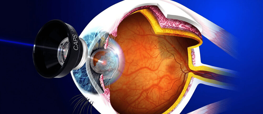 Laser ophtalmologique YAG
