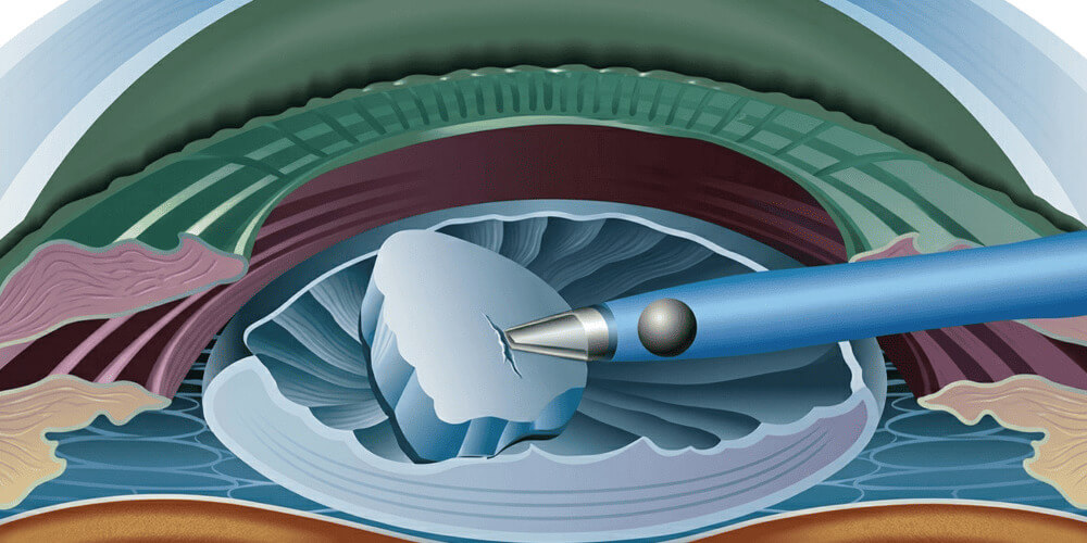 Chirurgie de la cataracte