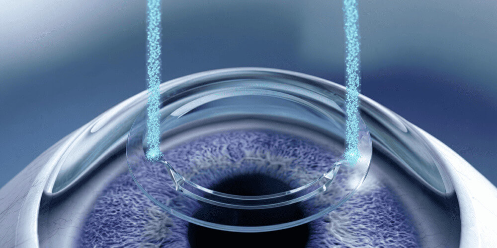 Chirurgie réfractive TransPKR